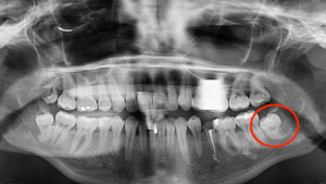 Avulsion des dents de sagesse