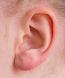 Chirurgie des oreilles décollées